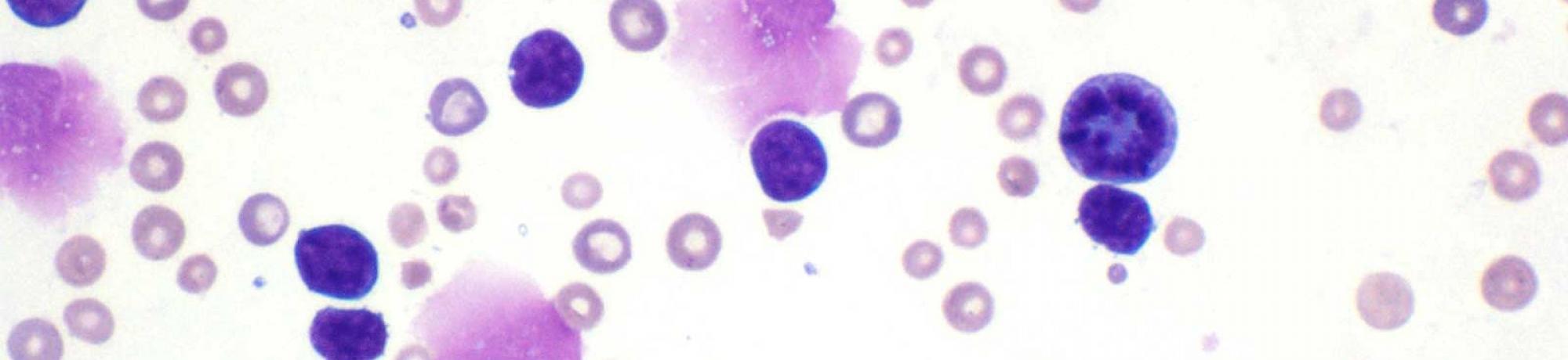 Blood smear from leukemic mouse
